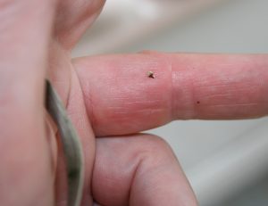 Bee Stung